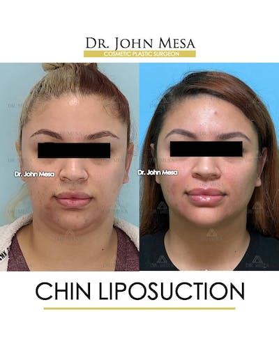 Patient 157104125 Chin Liposuction Before And After Photos Dr Mesa