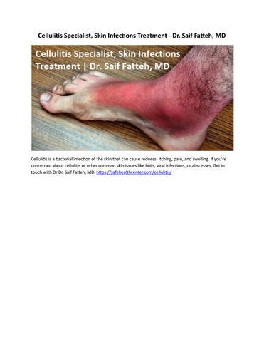 Cellulitis Specialist, Skin Infections Treatment - Dr. Saif Fatteh, MD ...