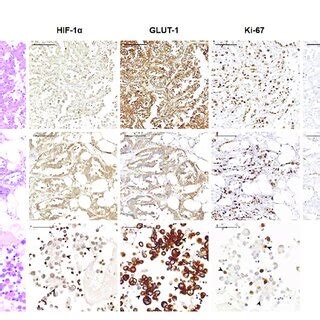 Representative Images Showing HIF 1a GLUT 1 And Ki 67 Expression Of