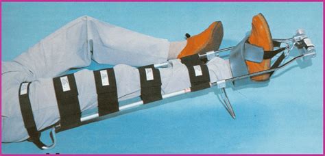 Femur Fracture in the ED - Remove the Traction - County EM