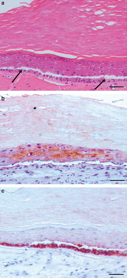 Epidermal Blister Formation In Pachyonychia Congenita PC Regenerated