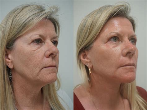 Benefits Of Renuvion Skin Tightening Advanced Plastic Surgery