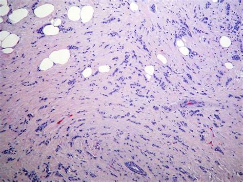 Capillary hemangioma (lower lip) – BosnianPathology