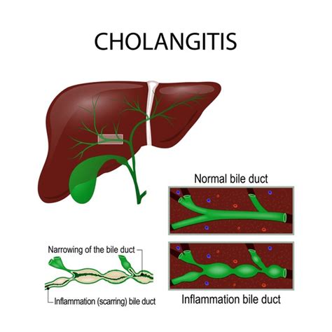 Biliary Duct Over Royalty Free Licensable Stock Vectors Vector