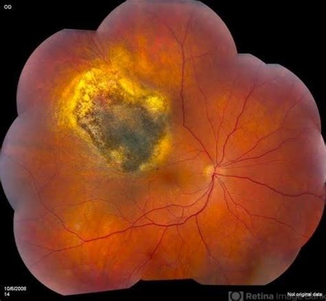 Treated Choroidal Melanoma Retina Image Bank