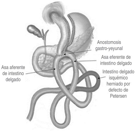 Hernia De Petersen Sintomas BRAINCP