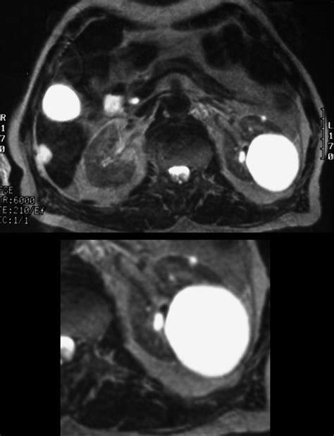 finding cyst simple mri kidney