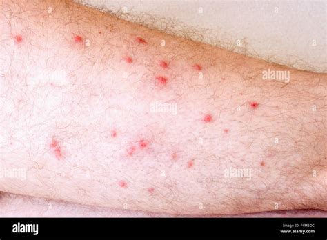 Allergic reaction to the leg Stock Photo - Alamy