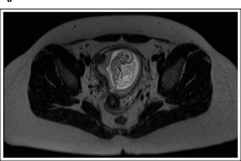 Figure From Apparent Heterotopic Pregnancy Created By Mirror Image