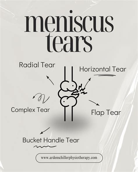 Arden - 💥MENISCUS TEARS – let’s break it down💥 A meniscus tear is one