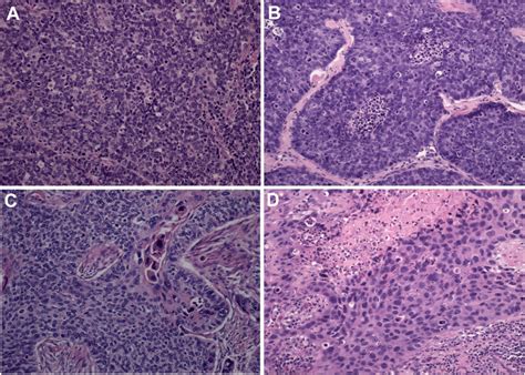 The Photomicrograph Shows Morphological Features Of A Small Cell Lung