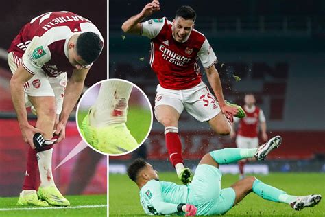 Arsenal Blow As Gabriel Martinelli Limps Off Injured Against Man City