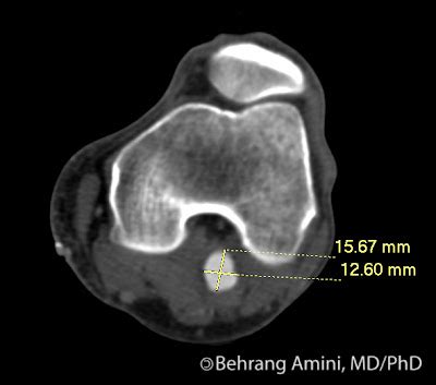 Roentgen Ray Reader: Popliteal Artery Aneurysm