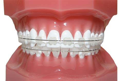 Bright Series Ceramic Bracekts Brilliant Orthodontics Orthodontic