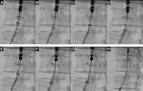 Reverse Slider Technique Using The Endurant Stent Graft For Accurate