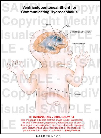 Ventriculoperitoneal Shunt for Communicating Hydrocephalus