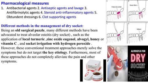 Alveolar Osteitis Dry Socket Pdf