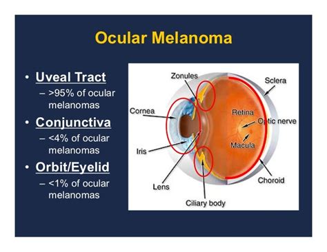 Systemic Treatments For Uveal Melanoma