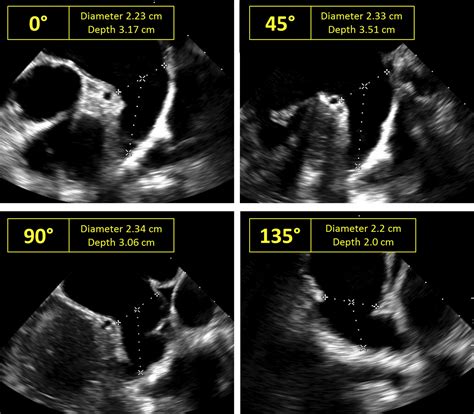 Echocardiographic Guidance Of The Novel Wavecrest Left Atrial Appendage