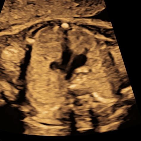 Fetal Echocardiography | FDCAZ