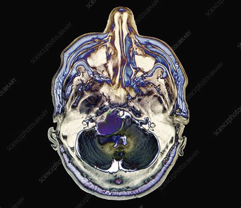 Meningioma Brain Cancer MRI Scan Stock Image C038 8666 Science