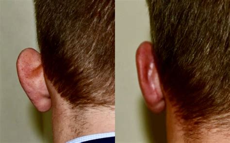 Prominent Ear Correction Edinburgh Otoplasty Waterfront