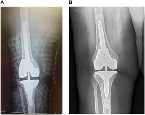 Frontiers Comparing Revision Total Knee Arthroplasty Stems At A High Volume Revision Center