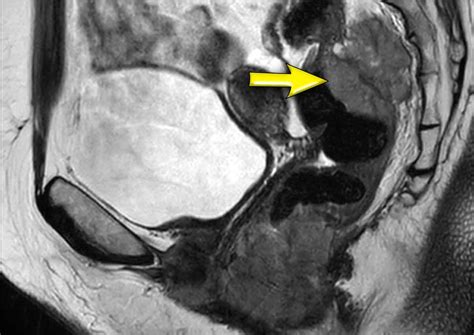 The Radiology Assistant Anal Cancer Staging