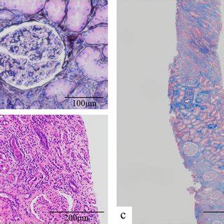 The Pathological Findings Of The First Renal Biopsy A Light