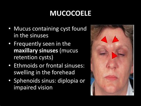 paranasal sinuses anatomy physiology  diseases powerpoint