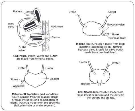 seeking healthy life    urostomy surgery types  urostomy