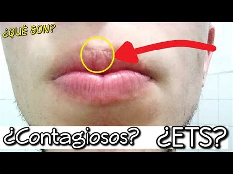 Porque Me Salen Espinillas En Los Labios De La Boca Bambinos Web