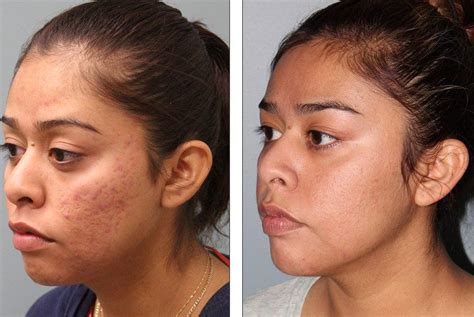 Fractional Co2 Laser Before After Skin Resurfacing