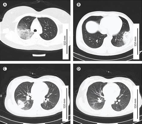 Human To Human Transmission Of Chlamydia Psittaci In China 2020 An