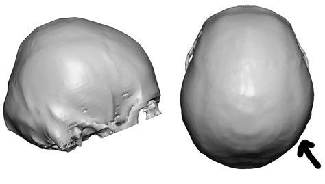 Plastic Surgery Case Study Custom Skull Implant For Improved Back Of