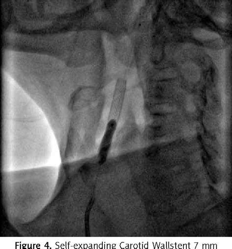 Figure 1 From Transradial Approach For Carotid Artery Stenting In A