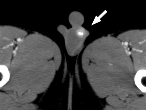 Benign Large Cell Calcifying Sertoli Cell Tumor Of The Testis In A