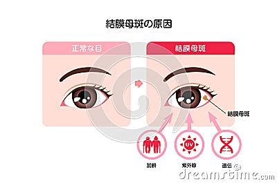 Causes Of Conjunctival Nevus Vector Illustration Royalty-Free Cartoon ...