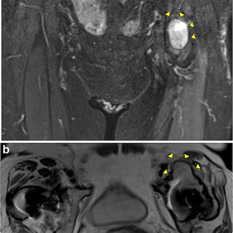 Coronal T2-weighted short tau inversion recovery (STIR) (a) and axial ...