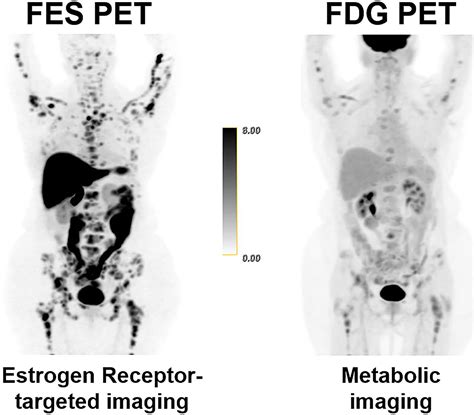 Pet Scan Cancer