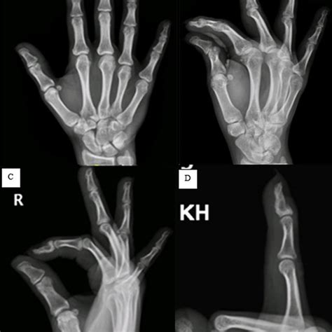 Follow Up Radiographs At Three Months Post Operative Of The Right Hand