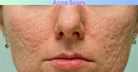 Addressing Acne Scars A Comprehensive Guide To Treatment And