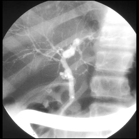 Pediatric Primary Sclerosing Cholangitis Pediatric Radiology