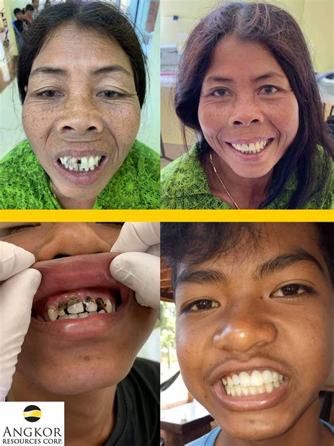 Angkor Delivers Dental Care Campaign In Rural Cambodia Angkor