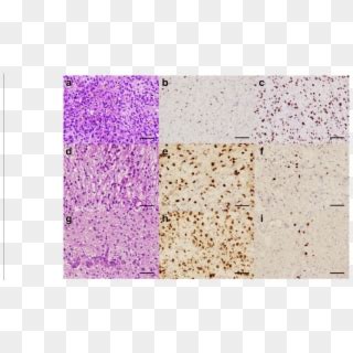 At Initial Diagnosis, H&e Stain Shows A High Grade - Art, HD Png ...