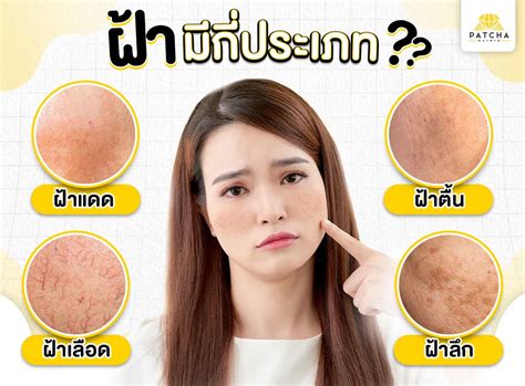 เมโสฝ้ากระคืออะไร รักษาฝ้ากระได้จริงไหม สามารถหายขาดเลยได้ไหม
