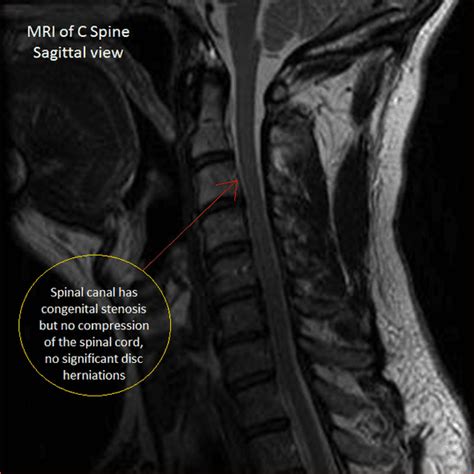 Case Studies Series Cervical Foraminotomy Neurosurgeons Located In
