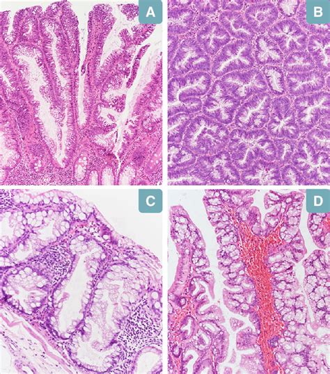 Histological Aspects Of Polypoid Lesions Tubulo Villous Adenoma With Download Scientific