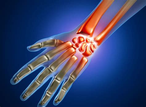 Разрыв связок лучезапястного сустава — лечение, последствия и симптомы ...