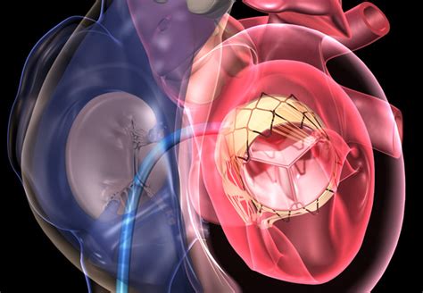 Percutaneous Transfemoral Transcatheter Mitral Valve Replacement Of A